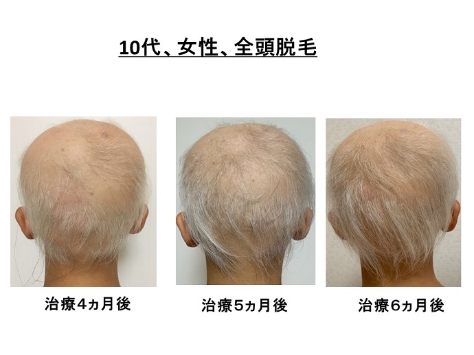 治療で白髪が生えてきても、徐々に黒くなっていきます！ 患者様からの声・メディア掲載・クリニックからのお知らせ 名古屋Kクリニック